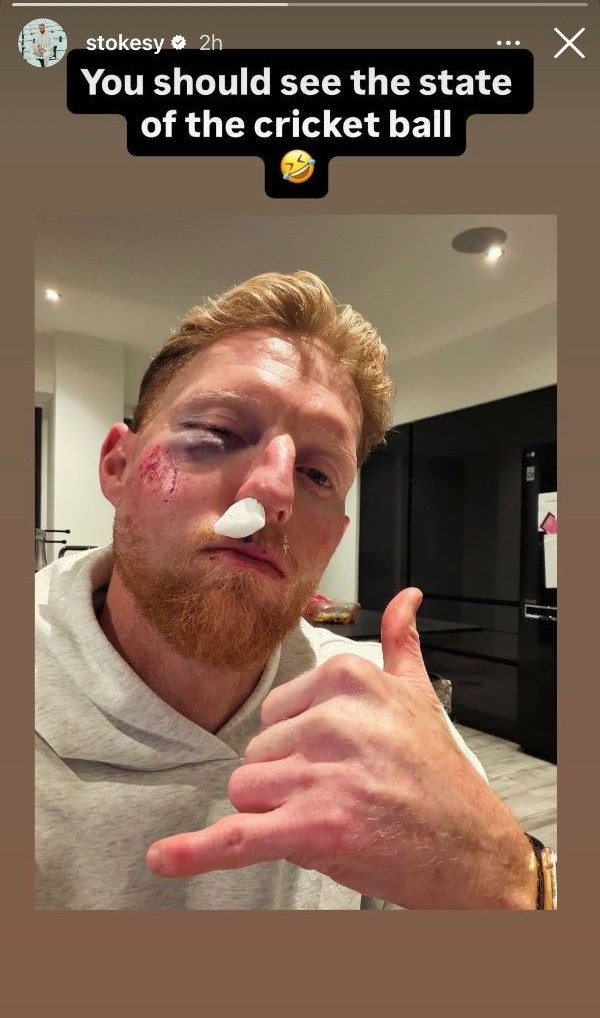 Ben Stokes Reveals Shocking Facial Injury After Cricket Ball Strike